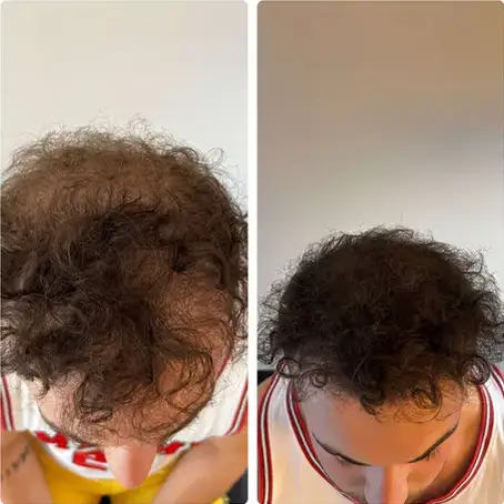 Avant/après micropigmentation
