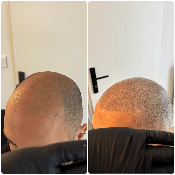 Résultat micropigmentation — calvitie