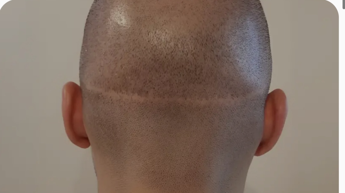 Densification homme