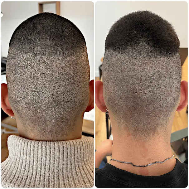 Micropigmentation pour cicatrices de greffe FUT FUE