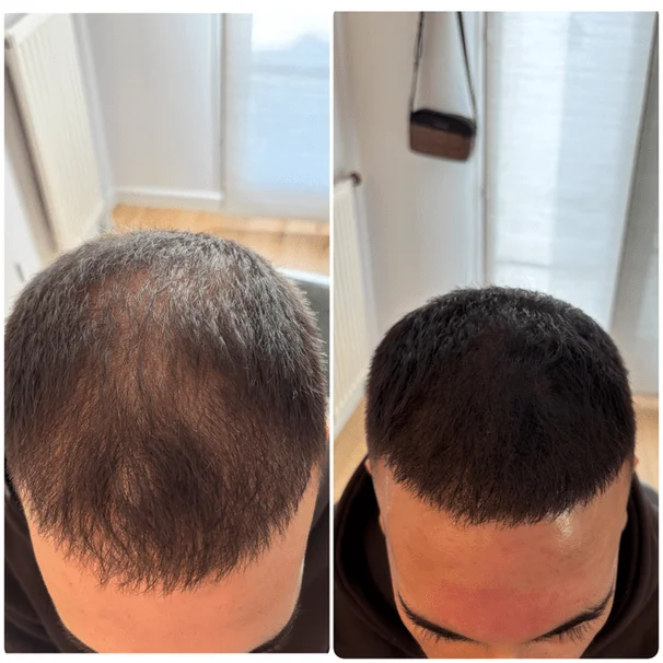 Résultat micropigmentation — effet densité