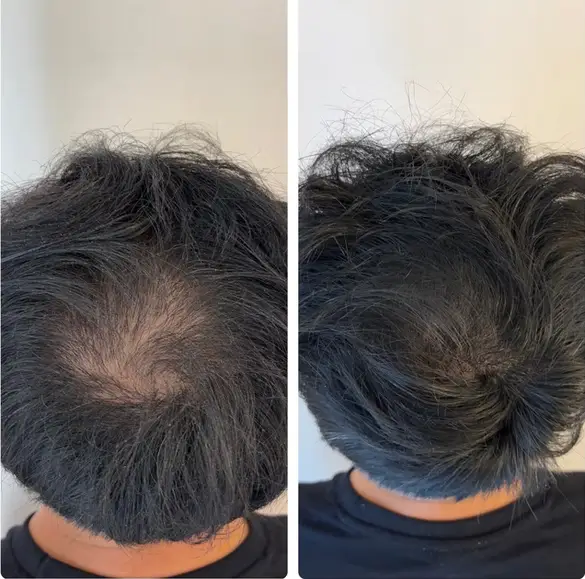 Résultat micropigmentation — homme tête rasée